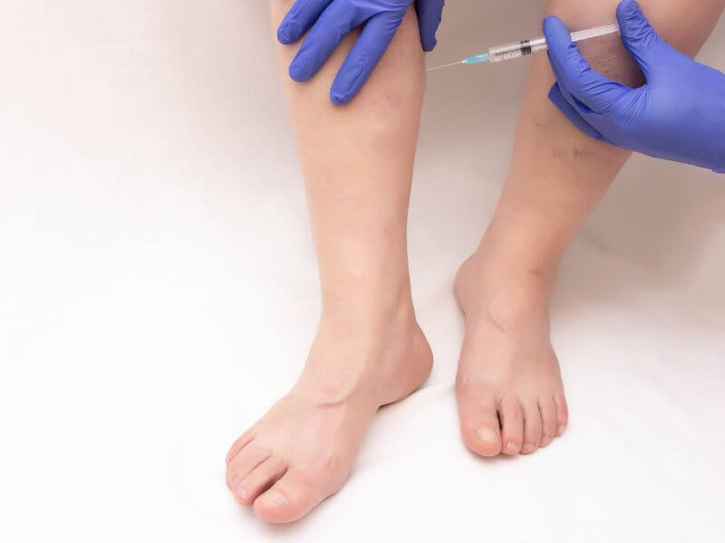 Varicose Vein Treatment 7 Conditions that Qualify for Insurance